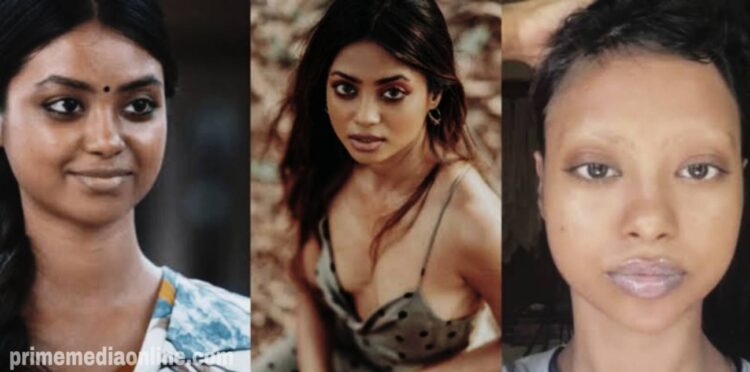 രോഗാവസ്ഥ വെളിപ്പെടുത്തി നടി ഷോൺ റോമി: തലമുടി അടക്കം കൊഴിഞ്ഞുപോകുന്ന സാഹചര്യം ആയിരുന്നു, രണ്ടാഴ്ച കൂടുമ്പോൾ സ്റ്റിറോയ്ഡ് ഇൻജക്ഷൻ